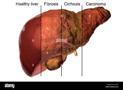 Fetor Hepaticus Treatment : Pour un monde plus juste. - Juventu dugtleon