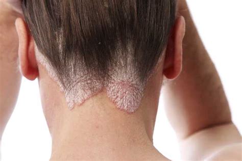 Seborrheic Dermatitis Scalp Hair Loss