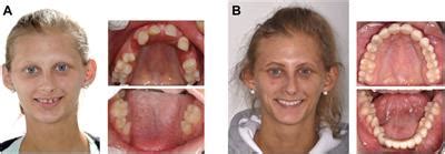 Frontiers | Ectodermal dysplasias: New perspectives on the treatment of ...