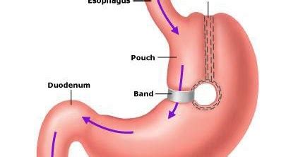 Vertical banded gastroplasty Complications, Advantages, Disadvantages ...