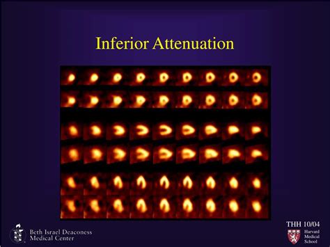 PPT - Attenuation Artifacts PowerPoint Presentation, free download - ID:3380940