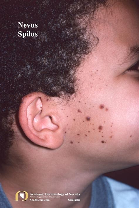 Nevus Spilus: Speckled Lentiginous Nevus... - Academic Dermatology of Nevada