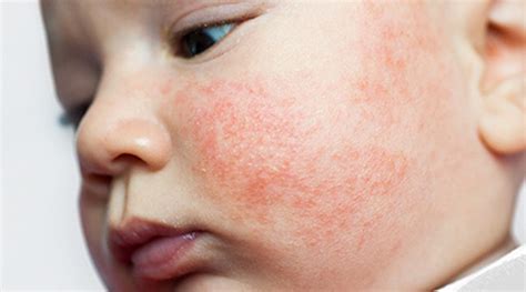 Pictures Of Childhood Rashes: Red Dots, Bumps, And More, 50% OFF