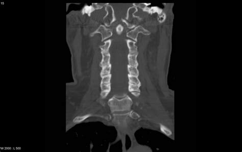 Occipital Condyle Fracture - radRounds Radiology Network