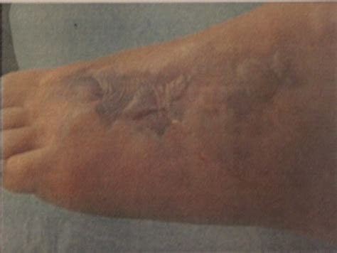 Aggressive Necrotizing Fasciitis in a 12-Year-Old Girl of Unknown Etiology: Diagnosis, Therapy ...