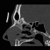 Foramen cecum | Radiology Reference Article | Radiopaedia.org