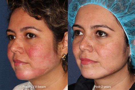 What Is Difference Between V Beam Laser And Ipl - The Best Picture Of Beam