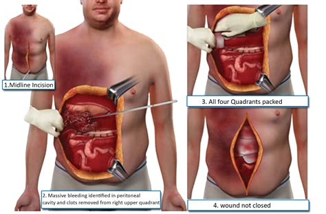 Laparotomy and Laparoscopy: Everything you need to know - Jalal Surgical