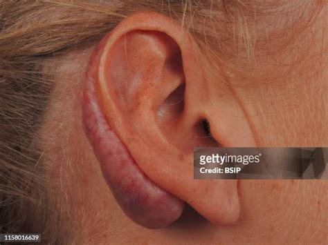 Keloid Scar Photos and Premium High Res Pictures - Getty Images