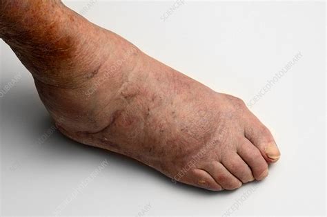 Top Of The Foot Arthritis Causes Symptoms Best Treatm - vrogue.co