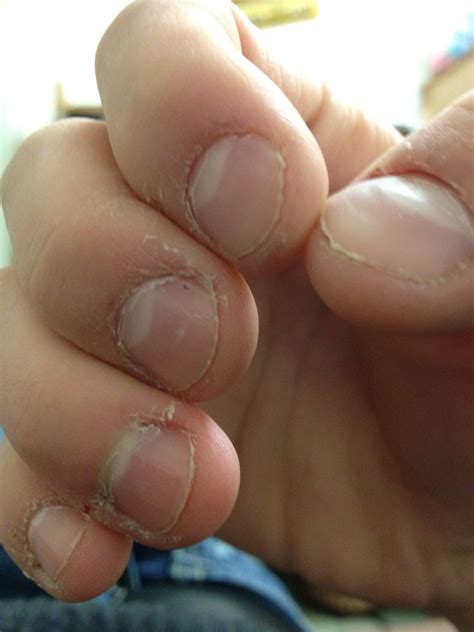 File:Nail and cuticle bitting.JPG - Wikimedia Commons