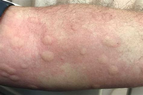 Common Rashes: An Overview | Ausmed