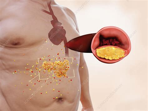 Visceral fat and heart disease, illustration - Stock Image - F021/2794 - Science Photo Library