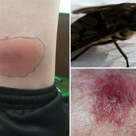 Horse Fly Bite Itchy For Weeks at Calvin Sparrow blog