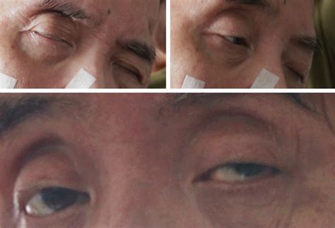 stroke patient's ability to respond to object from opening his eyes ...