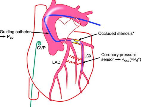 Assessment of the Human Coronary Collateral Circulation | Circulation