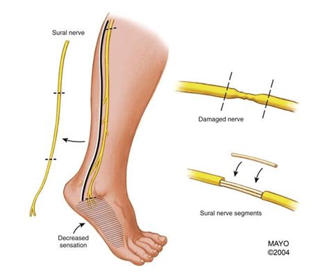 Sural Nerve Pain - fingersandfeathersh