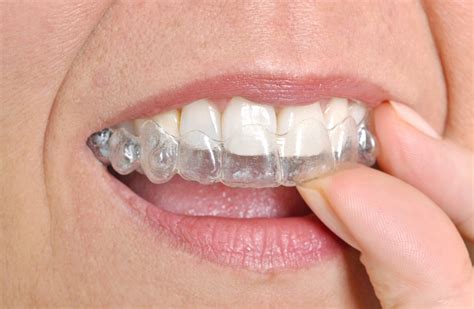 Invisible Alternatives to Traditional Braces | Orthodontic Associates