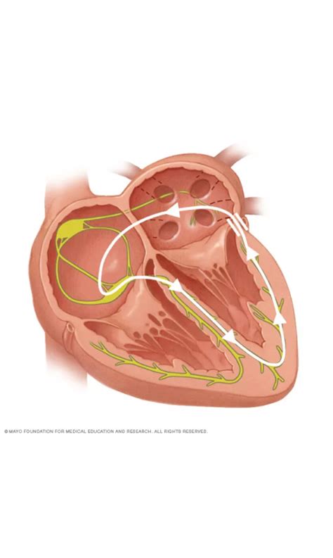 Catheter Ablation For PSVT At Dr Karthigesan Clinic, Chennai