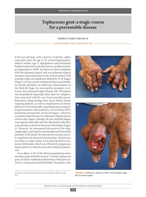 (PDF) Tophaceous Gout: a tragic course for a preventable disease