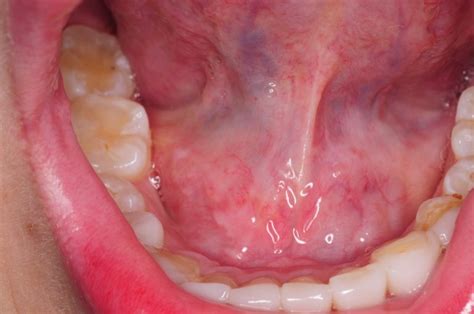 Swelling Related to Ranula Under The Tongue | Swelling Related to ...