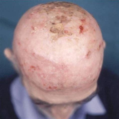 (PDF) Treatment of multiple scalp cylindroma