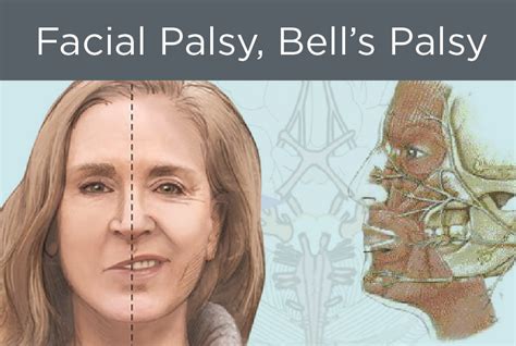 Merit + Point – The Bell’s Palsy Condition