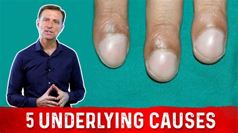 What Causes Clubbing of the Nail? - YouTube