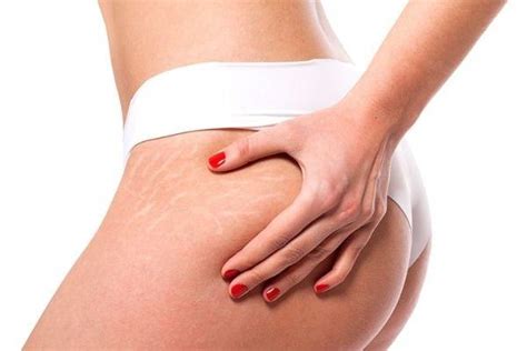 What Are Stretch Marks? Causes, Remedies, and Prevention