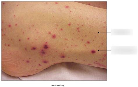 Petechiae and Purpura Diagram | Quizlet