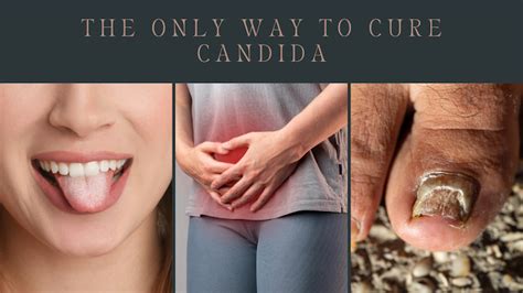 The Only way to Cure Candida