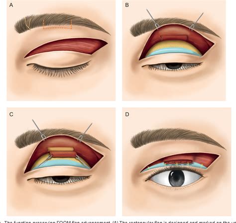 Figure 1 from The Function-Preserving Frontalis Orbicularis Oculi ...