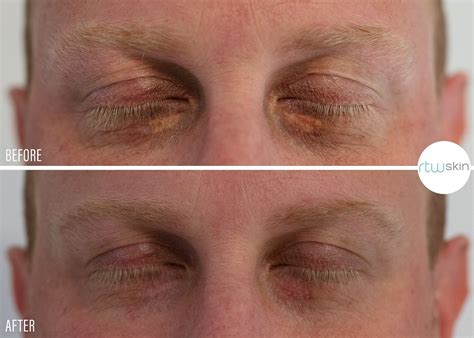 Xanthelasma Removal Cream