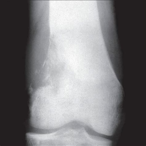 Fibrosarcoma (Malignant Fibrous Histiocytoma) | Basicmedical Key