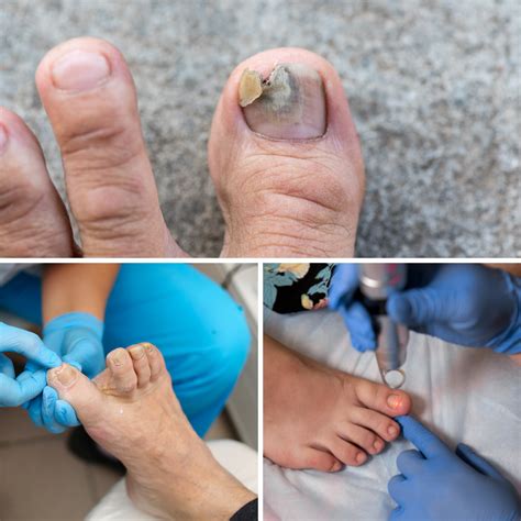 The 6 Types Of Toenail Fungus Conditions | by Carlimuja | Medium