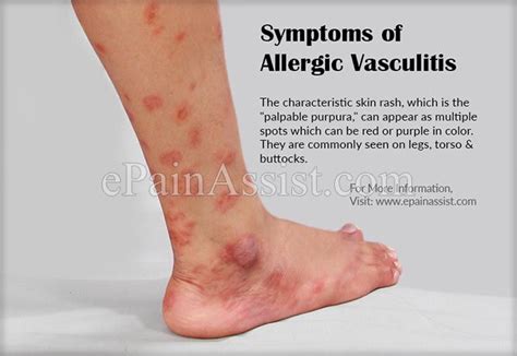 Symptoms of Hypersensitivity Vasculitis or Allergic Vasculitis ...