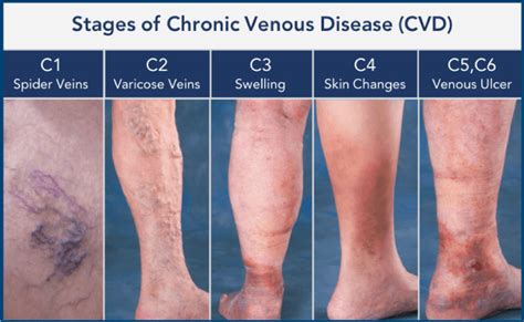 Chronic Venous Insufficiency Peripheral Venous Disease Vein Disease | My XXX Hot Girl