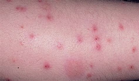 Flea Bites on Humans – Symptoms, Treatment, Pictures | hubpages