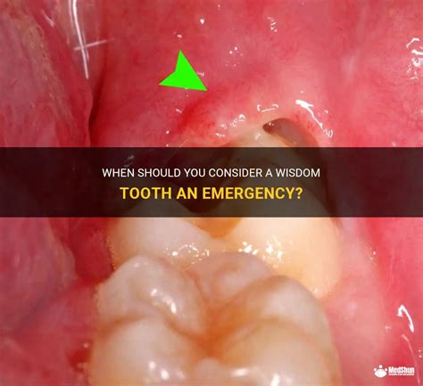When Should You Consider A Wisdom Tooth An Emergency? | MedShun