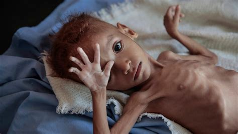 Aid group: 85,000 children may have died of hunger in Yemen | CTV News