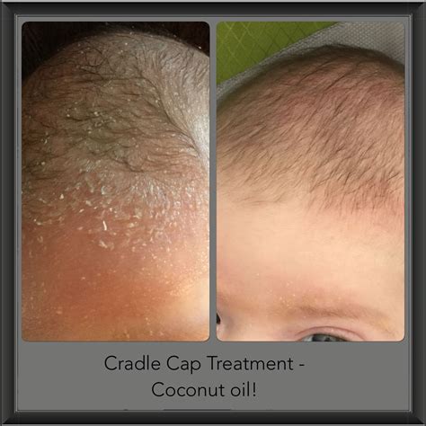 Cradle Cap Remedy - All Natural, No Chemicals - Coconut Oil!! | Cradle ...