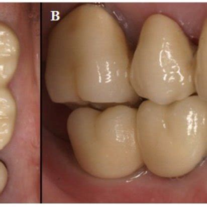 (PDF) Bone necrosis around dental implants: A patient treated with oral ...