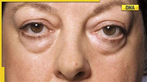 Thyroid eye disease: Symptoms, causes and treatment of this disorder