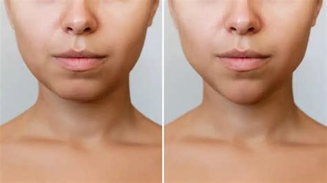 Sculptra Jawline Before and After Use Transformations