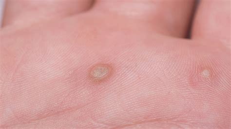 73 Images Of Viral Warts For FREE - MyWeb