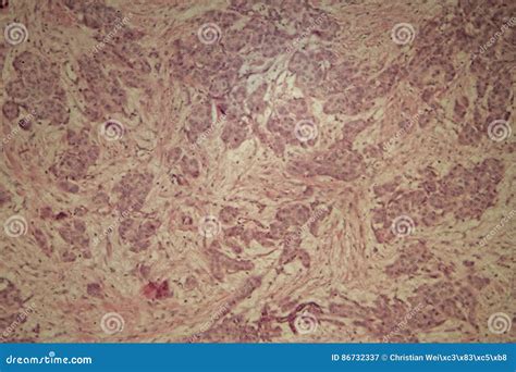 Breast Cancer Under the Microscope Stock Image - Image of magnification, neoplasm: 86732337