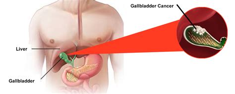 Gallbladder Cancer - Gallbladder Cancer Treatment Case Study