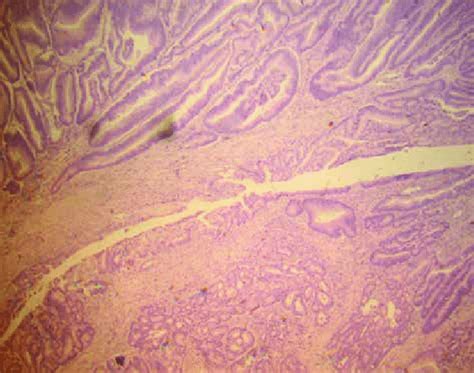 Tubular adenocarcinoma of the ampulla of Vater. Histologic findings of ...