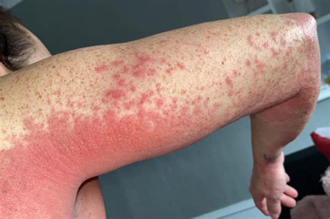 Woman suffers agonizing rash after Oxford-AstraZeneca COVID vaccine ...