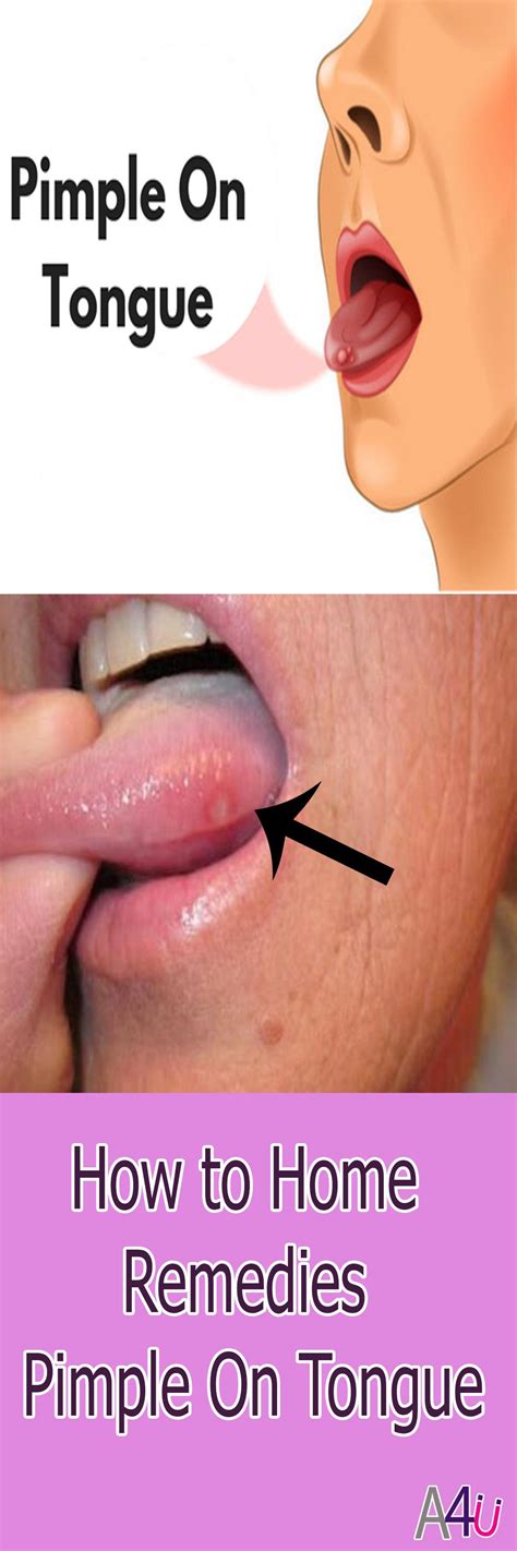 how to Home Remedies Pimple On Tongue | Sore Tongue | Tongue sores, Pimples remedies, Home ...